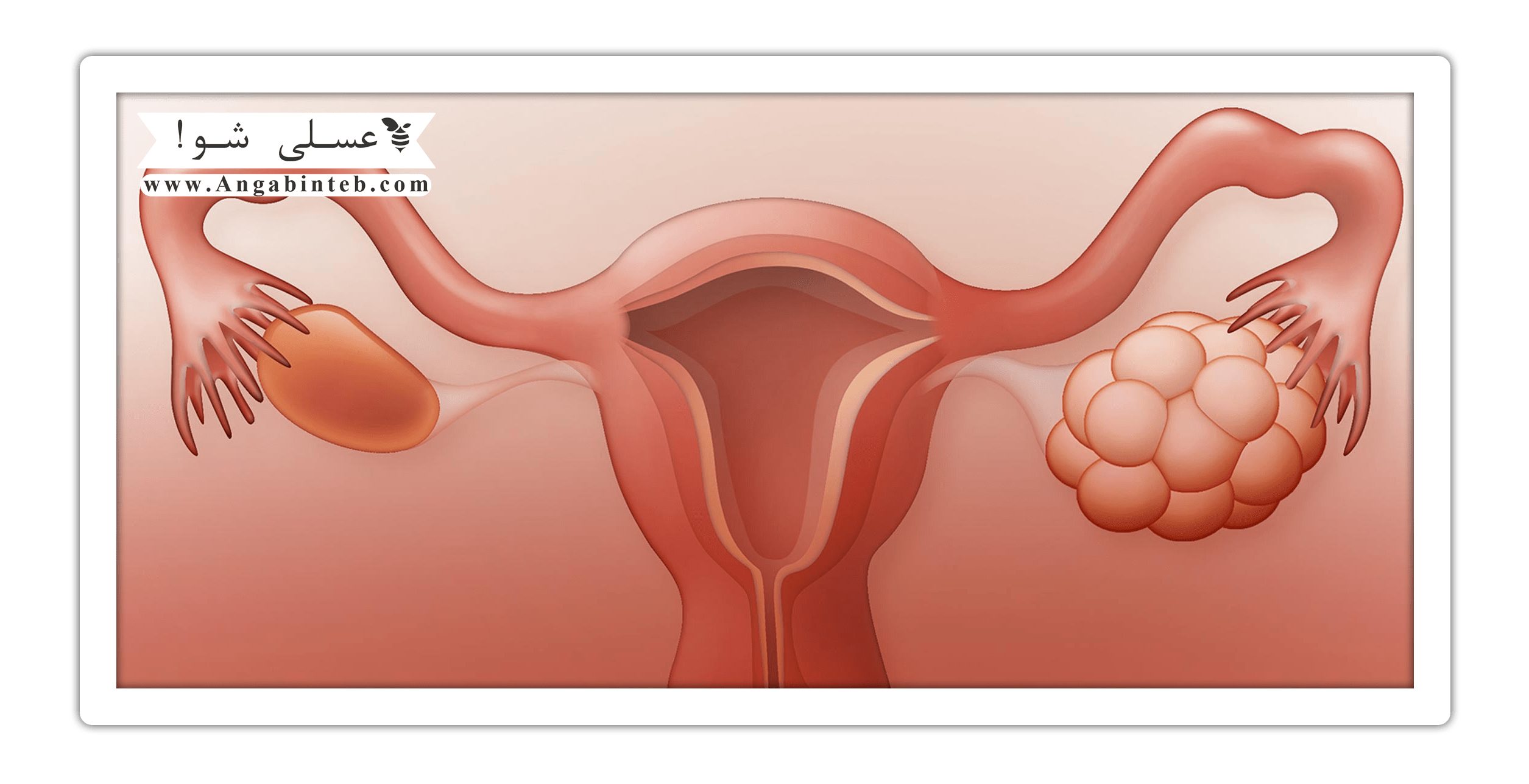 polycystic ovaries-title-min